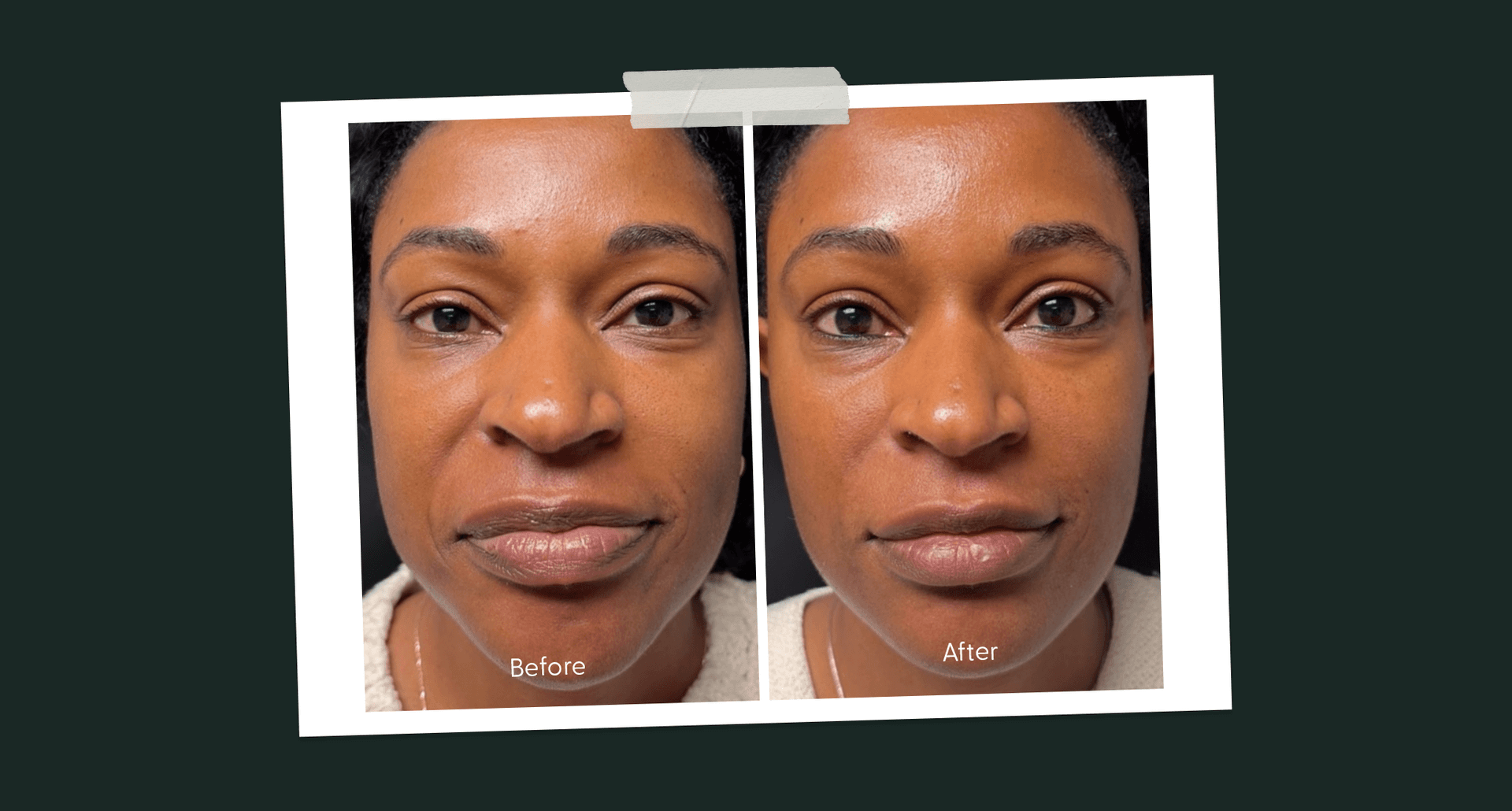 microneedling-before-and-after